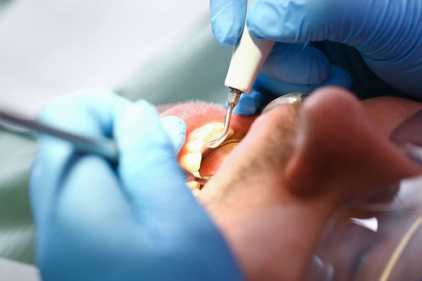Best Emergency Tooth Extraction in St Clairsville, OH
