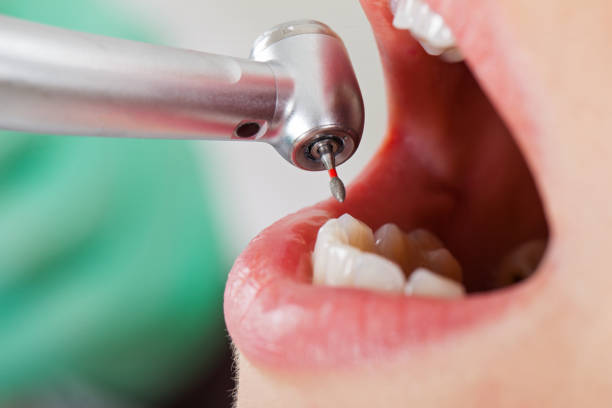 Best Emergency Tooth Extraction in St Clairsville, OH